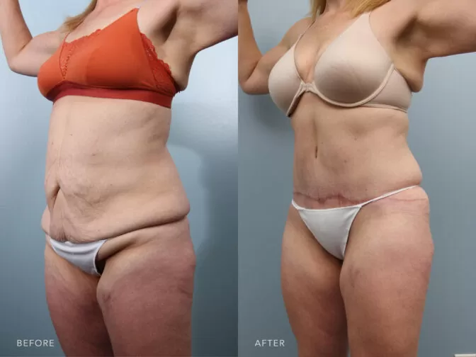 Side by side before and after of a woman's body from the neck to her knees in a bra and underwear from the oblique angle before and after tummy tuck surgery. Before surgery she had loose and sagging skin in her abdomen, after surgery the skin was pulled tight and excess fat and skin were removed causing her to look tight and toned. | Albany, Latham, Saratoga NY, Plastic Surgery