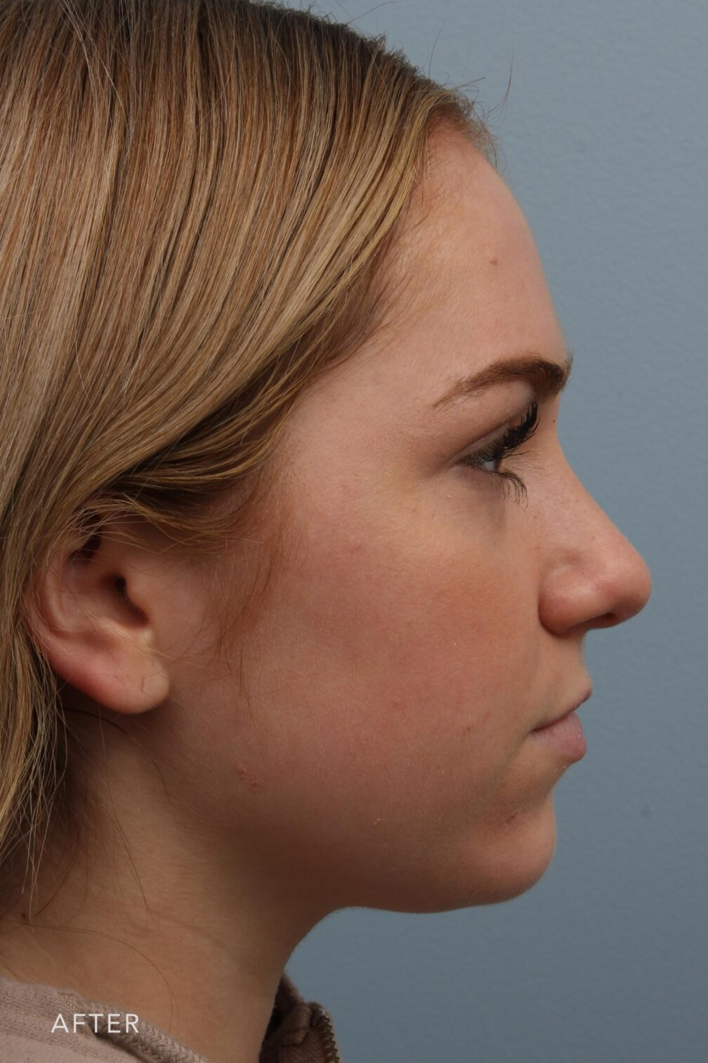 Rhinoplasty & Nasal Reconstruction Pictures | Williams Center Williams ...