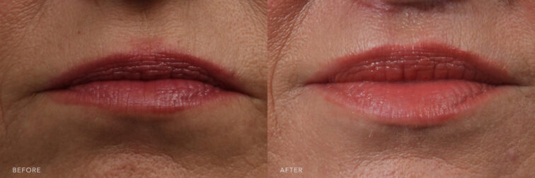 Side by side before and after of a woman's lips from the front angle very close up. Before lip lift surgery her top lip was smaller than her bottom lip. After surgery her top lip has been lifted to equal size of her bottom lip. | Albany, Latham, Saratoga NY, Plastic Surgery