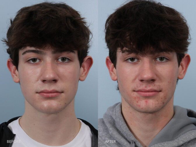 Side by side before and after of a teenage male with dark hair before and after ear surgery. Before his ears stuck out from his face giving him the appearance of very large ears. After surgery his ears were pinned back slightly making them rest more naturally to appear normally sized. | Albany, Latham, Saratoga NY, Plastic Surgery