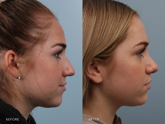 Side by side before and after of a teenage girl from the side profile before and after rhinoplasty surgery. Before surgery she had a slight nasal bump on the bridge of her nose, and a drooping tip. After surgery the bridge of her nose is straight and the tip is slightly lifted. | Albany, Latham, Saratoga NY, Plastic Surgery