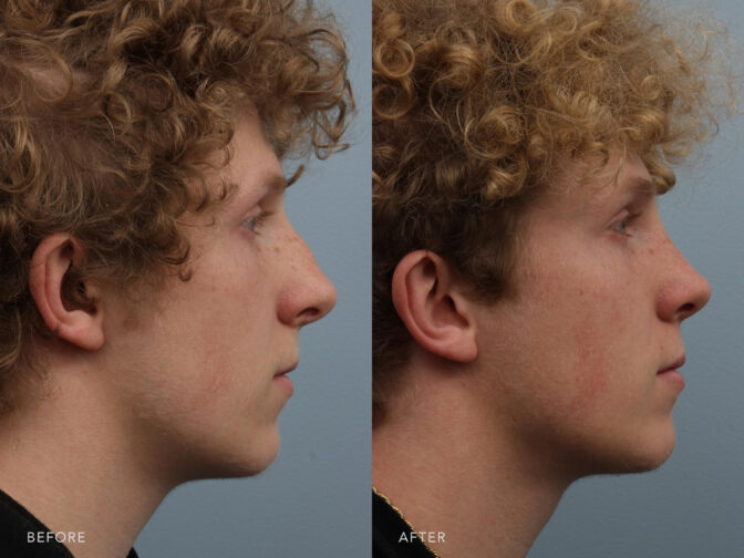Side by side before and after of a teenage male with blonde curly hair from the side profile view pre and post rhinoplasty surgery. Before rhinoplasty he had a large nasal bump. After surgery the bump was removed to give him a straight nasal bridge and lifted tip. | Albany, Latham, Saratoga NY, Plastic Surgery