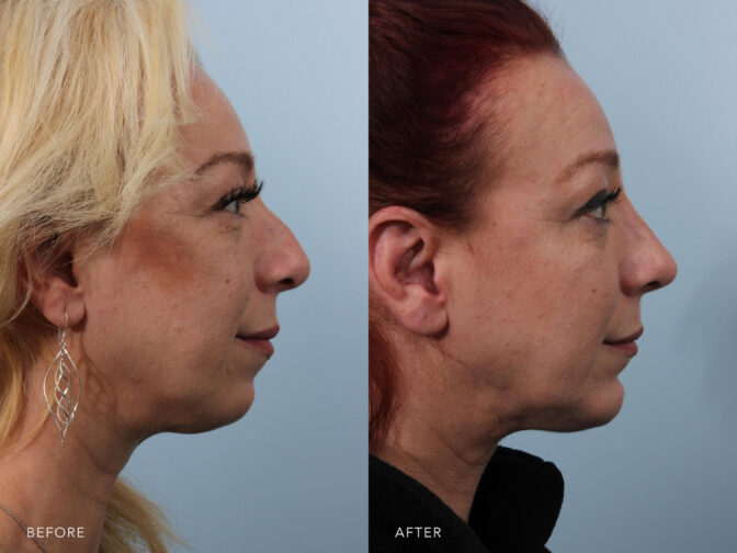 Side by side before and after of a woman's face from the the side angle before and after rhinoplasty surgery. Before surgery her nose had a slight nasal bump, after surgery the bridge of her nose was straight. | Albany, Latham, Saratoga NY, Plastic Surgery
