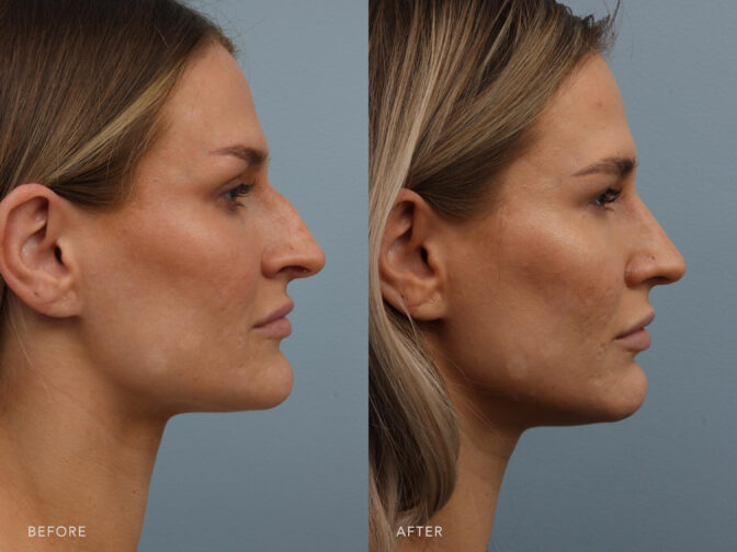 Side by side before and after of a blonde woman from the side angle before and after rhinoplasty surgery. Before surgery her nose had a large nasal hump and it was very masculine in appearance. After surgery her nose bridge is much straighter and feminine looking. | Albany, Latham, Saratoga NY, Plastic Surgery