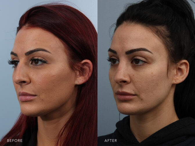 Before and after of a young brunette women from the oblique angle pre and post rhinoplasty surgery. Before surgery she had a nasal hump that made her nose appear larger than it really is. After surgery the bump was removed leaving her with a small feminine nose. | Albany, Latham, Saratoga NY, Plastic Surgery