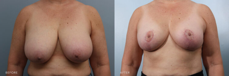 Side by side before and after of a woman's chest from the front angle before and after breast reduction surgery. Her breasts before were very large and had severe drooping. Her breasts after are significantly smaller and lifted. | Albany, Latham, Saratoga NY, Plastic Surgery