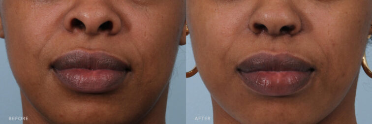 This is a photo of a woman's lower face before and after Cosmetic Rhinoplasty procedure. Before photo shows a wide base of her nose that makes her face look broad or wide while after photo shows tighter and narrow base on her nose that suits the shape of her face. |Albany, Latham, Saratoga NY, Plastic Surgery
