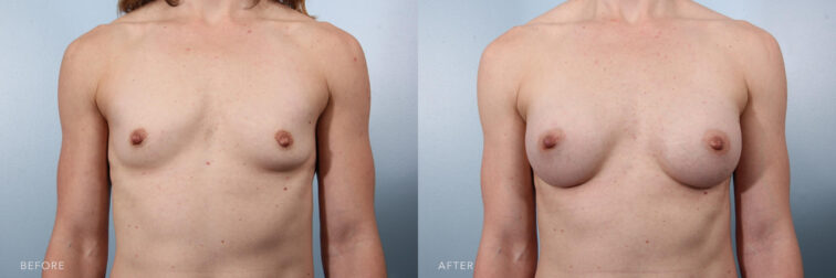 This is a profile photo of a woman's upper body before and after Bilateral Breast Augmentation procedure. Before photo shows tiny and deflated breasts while after photos shows more immense and rounded shaped breasts. | Albany, Latham, Saratoga NY, Plastic Surgery