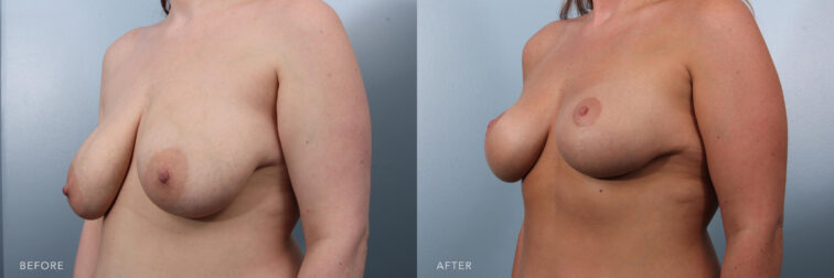A side by side view photo of a woman's upper body before and after Bilateral Mastopexy procedure.Before photo shows her hanging and bowed breasts while after photo shows more upward and standing up position of her breasts that conform with her flat abdomen.|Albany, Latham, Saratoga NY, Plastic Surgery