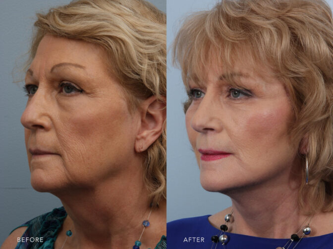 A side by side view profile photos of a blonde woman's face showing before and after the facelift procedure. Before surgery it shows vissible wrinkles and after surgery it emphasized smoothness look on her face. | Albany, Latham, Saratoga NY, Plastic Surgery