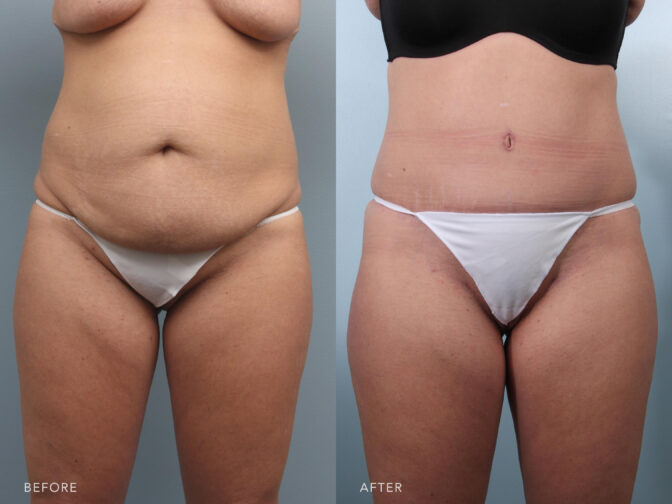 This is a photo of a woman's abdomen before and after Liposuction procedure. Before photo shows bloated and saggy skin on her belly while after photo shows slimmer and tightened skin that emphasized a well balanced abdominal shape.| Albany, Latham, Saratoga NY, Plastic Surgery
