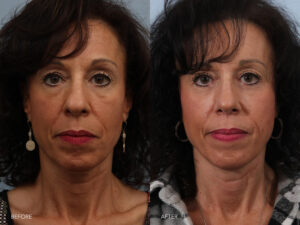 This is a photo of a woman's face with a black curly hair before and after Revision Rhinoplasty. Before photo shows her slighlty crooked and misalligned shape of her nose while after photo shows straight and more alligned view of her nose. |Albany, Latham, Saratoga NY, Plastic Surgery