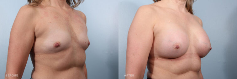 This is a side by side view photos of a woman's upper body before and after Breast Augmentation procedure. Before photo shows her tiny and flatten breasts while after photos shows her raised and puffed up breasts.|Albany, Latham, Saratoga NY, Plastic Surgery