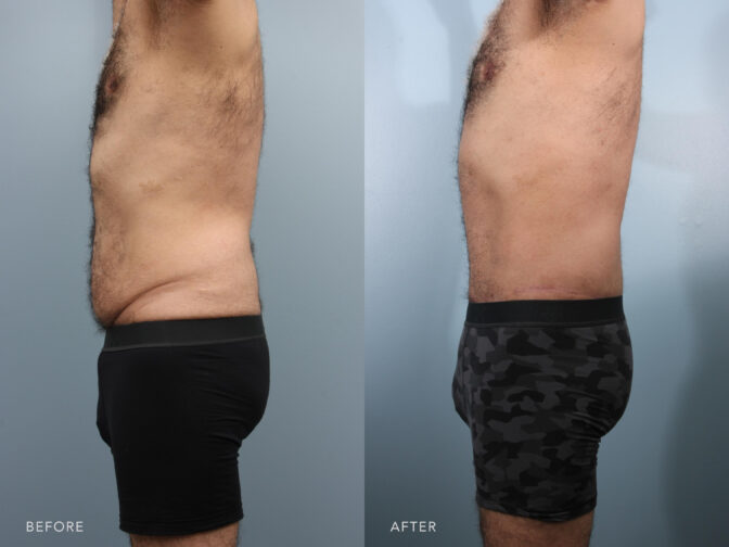 This is a photo of a man's lower body before and after Lower Body lift and Liposuction procedure. Before photo shows his baggy abdomen while after photo shows tighter and slimmer abdomen.|Albany, Latham, Saratoga NY, Plastic Surgery