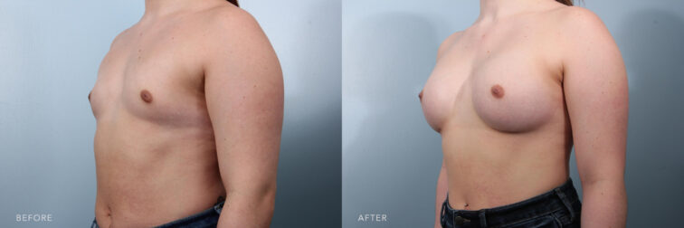This is a photo of a woman's upper body before and after Bilateral Augmentation Procedure. Before photo shows her flat chested breasts that made it looks like a man's upper body from a far while after photo shows her full-blossomed breasts which is more proportion to her body figure. | Albany, Latham, Saratoga NY, Plastic Surgery