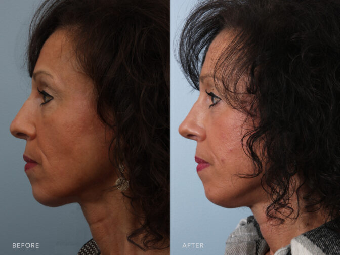 A side-by-side view of a woman's face before and after Nasal Septal Reconstruction procedure. Before photo shows a less nasal projection with her downward nose that extends forward from her face, contributing to the overall downward appearance. While the after photo shows a septum that is correctly centered within her nasal passages, creating a symmetrical division of the nose. | Albany, Latham, Saratoga NY, Plastic Surgery