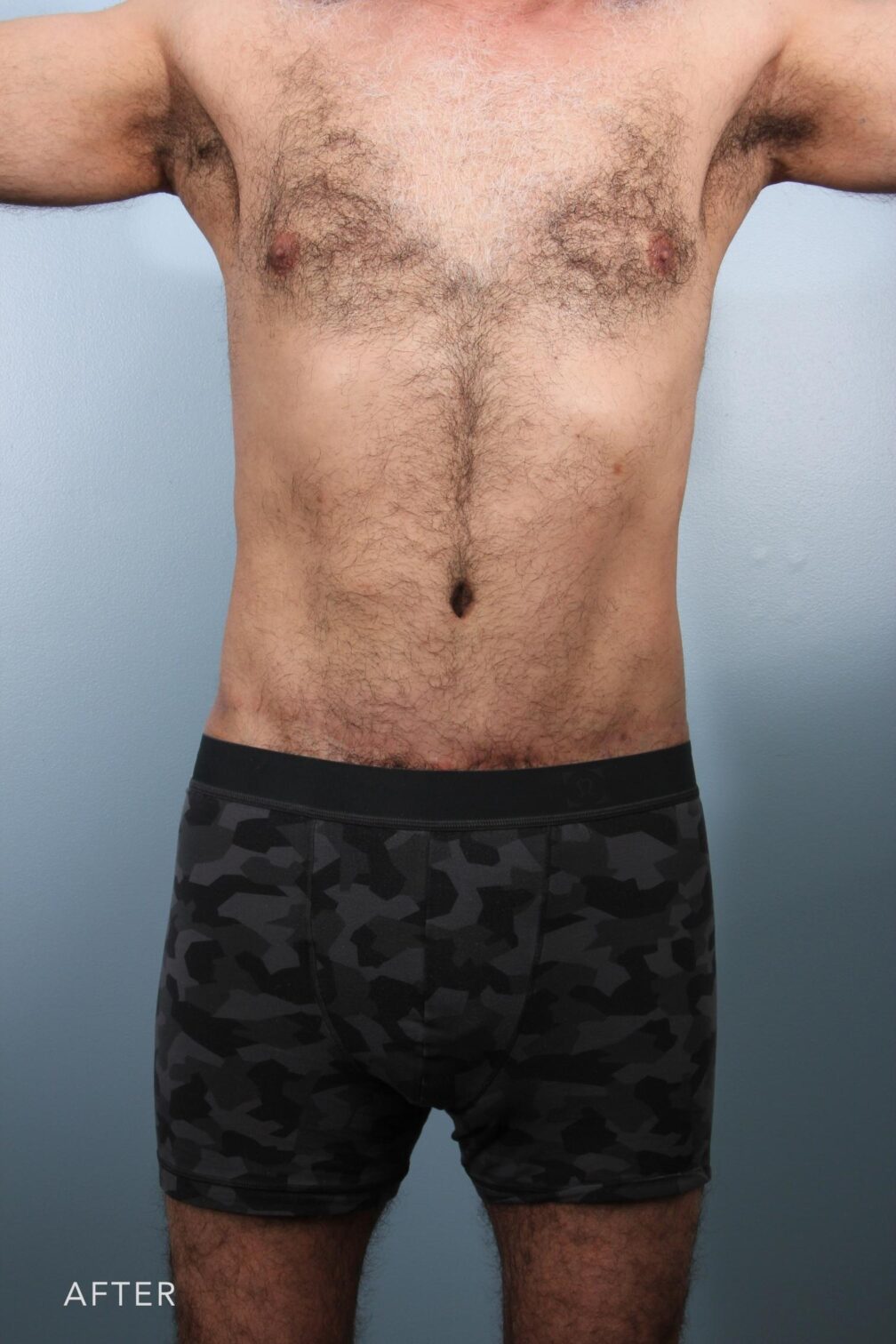 Body Lift Pictures Before & After Surgery Williams Center Williams Center