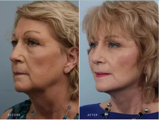 Patient showcasing before and after undergoing a deep plane facelift
