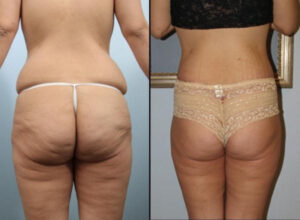 Patient before and after undergoing a BBL (Brazilian butt lift)