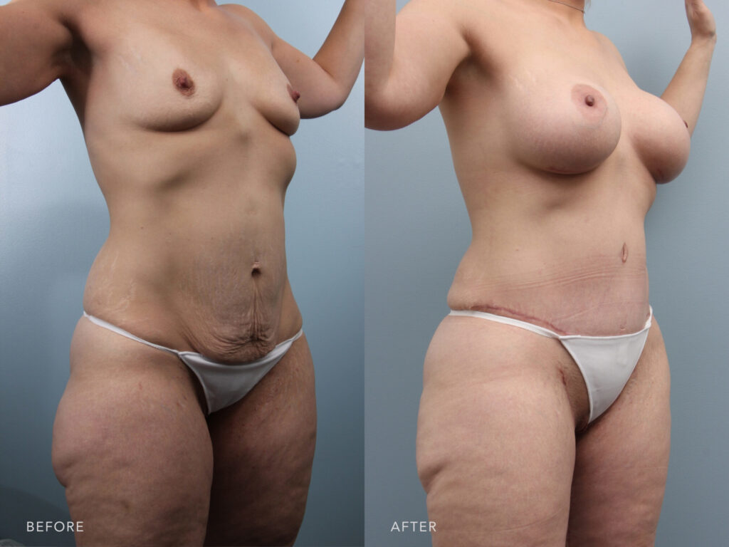 Results of a patient who had a mommy makeover surgery that included a tummy tuck with lipo 360 and breast augmentation