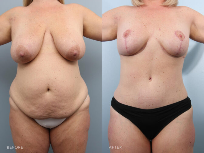 A photos of a woman's body before and after Abdominoplasty with Lipsuction and Bilateral Breast Lift procedure. Before photo shows her bulgy abdomen and saggy breasts while after photo shows her flatten abdomen and uptight breasts. | Albany, Latham, Saratoga NY, Plastic Surgery