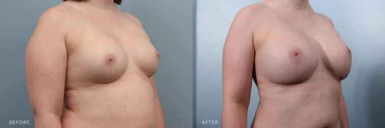 Before and after photo of a woman's breast before and after a breast augmentation. Before surgery on the right she had small breasts that didn't fit her larger frame. After surgery her breasts are larger and perkier while being more proportionate to her body. | Albany, Latham, Saratoga NY, Plastic Surgery