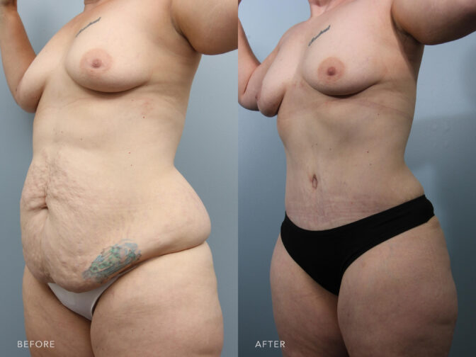 This is a side by side view photos of a woman's body before and after Abdominoplasty with Liposuction procedure. Before photo shows her baggy abdomen while after photo shows her tighter and evenly shaped abdomen. | Albany, Latham, Saratoga NY, Plastic Surgery