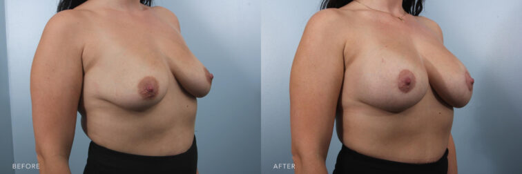 This is a side by side view photo of a woman's upper body wearing a black pants before and after Bilateral Breast Augmentation procedure. Before photo shows her shrunken breasts while after photo shows her ballooned sized of breasts. | Albany, Latham, Saratoga NY, Plastic Surgery