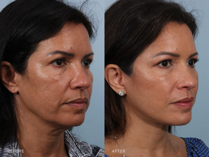 A side by side view photos of a woman's face with a black hair before and after Deep Plane Lower Face & Neck Lift procedure. Before photo shows her saggy and jagged jowls while after photo shows evenly and well balanced jawline. | Albany Latham, Saratoga NY, Plastic Surgery