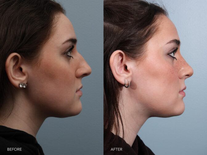 This is a side by side view photos of young woman's face before and after Endonasal Cosmetic Rhinoplasty procedure. Before photo shows her misshaped and bowed nose while after photo shows her shapely and upward angle of her nose. | Albany, Latham, Saratoga NY, Plastic Surgery