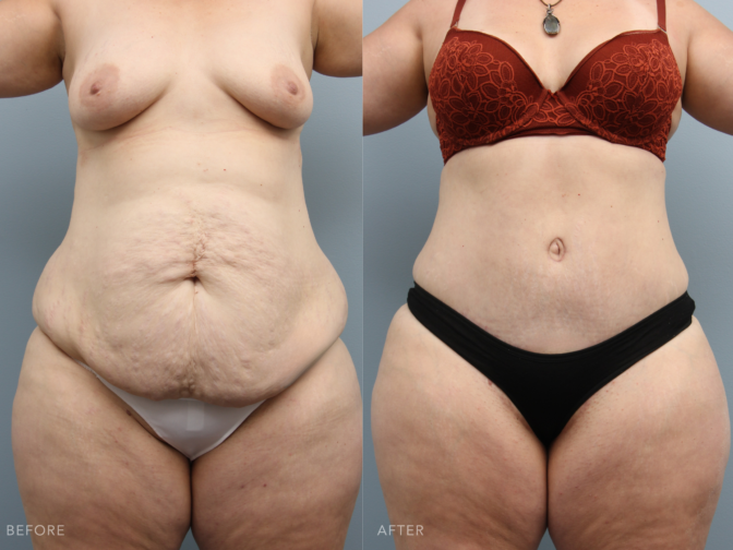 Mommy makeover