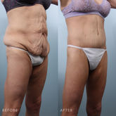 This is a side by side view of a woman's lower body wearing white underwear before and after Liposuction procedure. Before photo shows flabby and crumpled skin on her abdomen while after photo shows firm and flatten tummy that made it evenly shaped appearance. | Albany, Latham, Saratoga NY, Plastic Surgery