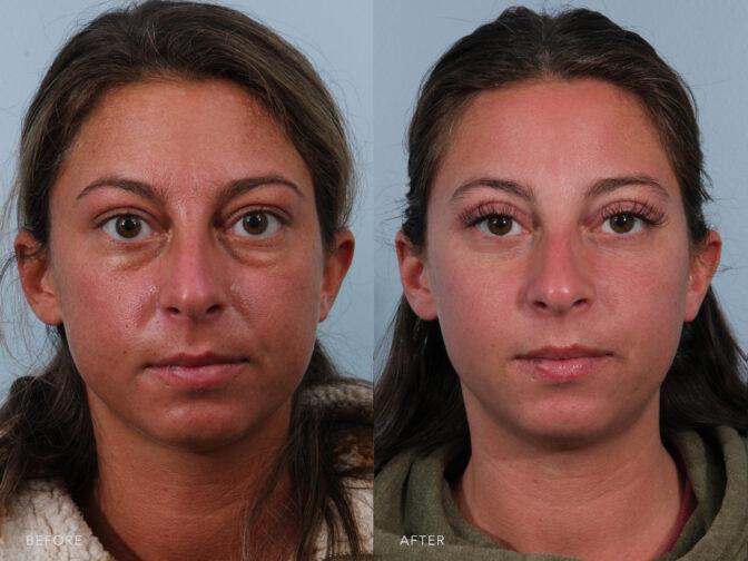 Before and after photo of a young woman with brown hair taken from the front angle pre and post blepharoplasty surgery. Her eyes have heavy bags before surgery and they were removed after surgery giving her smooth youthful undereyes. | Albany, Latham, Saratoga NY, Plastic Surgery