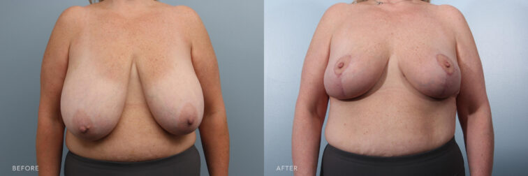 A photos of a woman's face before and after Bilateral Breast Reduction and Liposuction to the Back procedure. Before photo shows a hanging and large breasts while after photo shows an upraised and a smaller size of her breasts. | Albany, Latham, Saratoga NY, Plastic Surgery