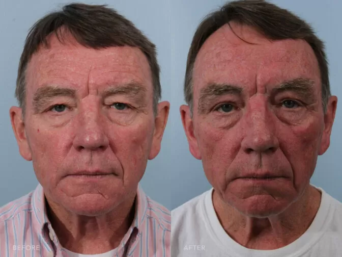 before and after of an older man from the front angle with brown hair pre and post brow lift surgery. Before surgery he had heavy upper eyelids that were weighing down his face. After surgery his eyes are more open and youthful. | albany, latham, saratoga NY, plastic surgery