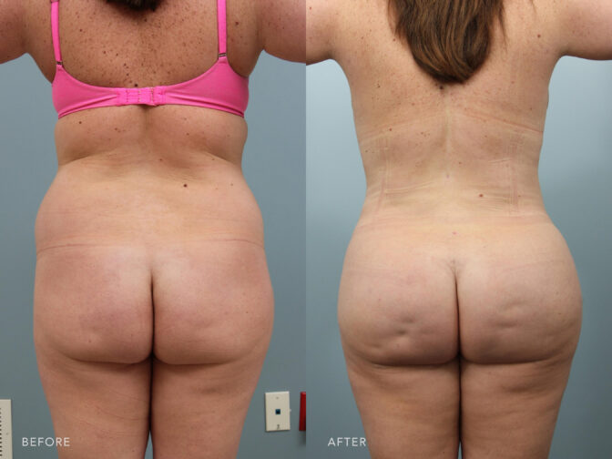 A photos of a woman's back before and after Liposuction with fat transfer procedure. Before photo shows her out of shape hips and buttocks while after photo shows her shapely hips and well rounded buttocks. | Albany, Latham, Saratoga NY, Plastic Surgery