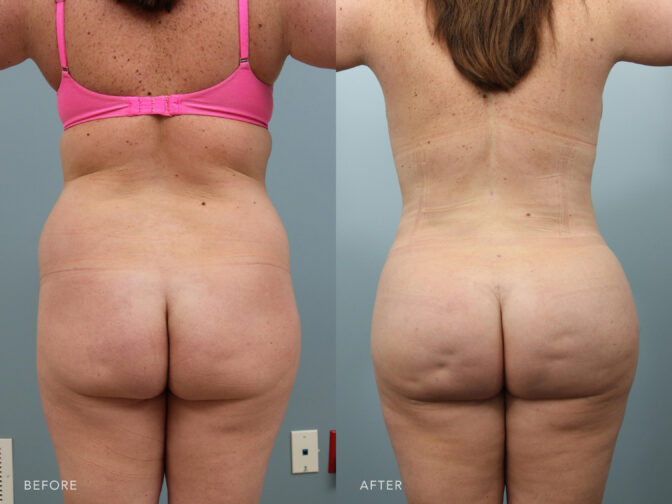 A photos of a woman's back before and after Liposuction with fat transfer procedure. Before photo shows her out of shape hips and buttocks while after photo shows her shapely hips and well rounded buttocks. | Albany, Latham, Saratoga NY, Plastic Surgery