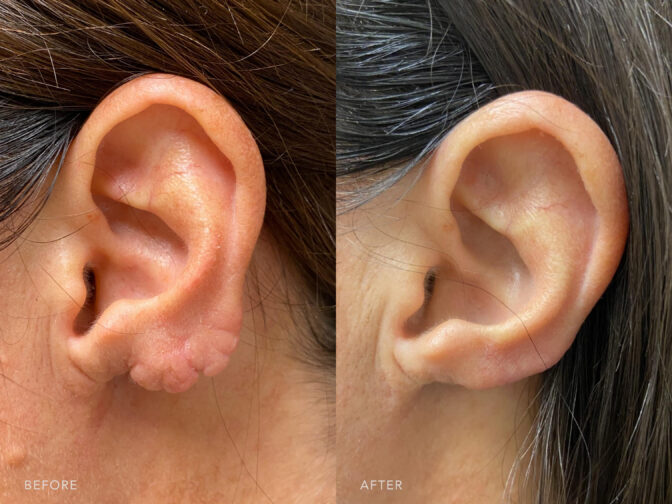 This is a side by side view photos of a woman's ear before and after Excision of Keloid Scar Tissue procedure. Before photo shows her deformed shaped ear due to the keloid scar while after photo shows her normal and natural shape of her right ear. | Albany, Latham, Saratoga NY, Plastic Surgery