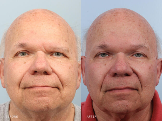 Before and after photo of an old bald man who had brow lift surgery. Before surgery his eyelids and eyebrows were weighed down causing his eyes to appear shut. After brow lift surgery his eyes are more open. | Albany, Latham, Saratoga NY, Plastic Surgery