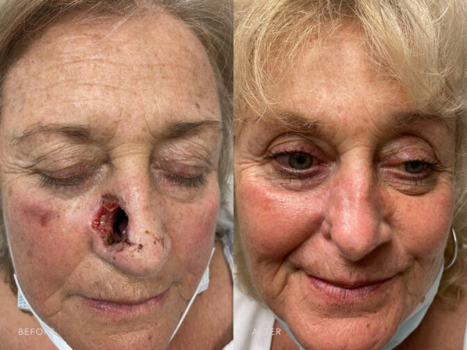 A photos of a woman's face before and after Reconstruction of MOHs Right Nasal Defect procedure. Before photo shows her open wound on her nose to perfom and repair tissue damage while after photo shows her reconstructed and restored nose appearance. | Albany, Latham, Saratoga NY, Plastic Surgery