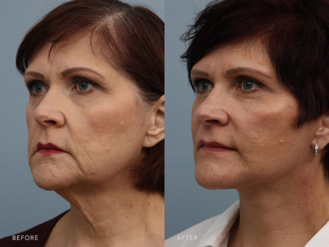Side by side before and after of a middle aged woman with auburn short hair from the oblique angle pre and post facelift surgery. Before surgery she had excess wrinkly neck skin and sagging jowls. After surgery the excess neck skin was removed and her jawline is sharp. | albany, Latham, Saratoga NY, Plastic Surgery