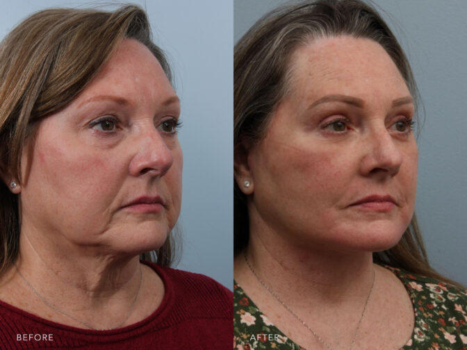 This is a side by side view photos of a woman's face before and after Deep Plane Lower Face and Neck Lift procedure. Before photo shows a saggy cheeks and jowls while after photo shows a more tighter skin and well formed jowls. | Albany, Latham, Saratoga NY, Plastic Surgery