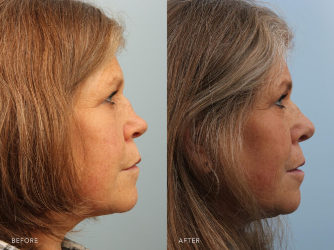 Before and after photo of a woman with shoulder length grey hair taken from the side profile angle before and after rhinoplasty surgery. Before her nose looked to be scooped out and missing the bridge, after her nose bridge is straighter and more proportional.
