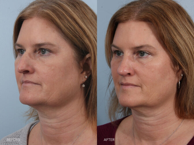 Before and After of a middle aged woman with strawberry blonde hair pre and post rhinoplasty surgery. Before surgery her nose was large and droopy. After surgery the nasal hump was removed and the tip was lifted giving her a more feminine looking nose. | albany, Latham, Saratoga, NY, Plastic Surgery