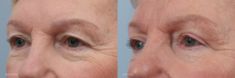 This is a side by side view photos of a woman's upper face before and after Excision of Excess Upper Eyelid Skin Bilaterally procedure. Before photo shows her baggy and crumpled skin on her upper eyes while after photo shows her smoother skin and brighter eyes. | Albany, Latham, Saratoga NY, Plastic Surgery