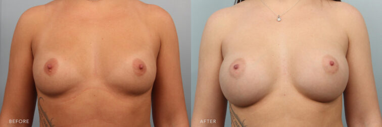 Side by side before and after of a woman's breast pre and post breast augmentation. Before surgery she had small round breasts and after surgery they are much fuller. | Albany, Latham, Saratoga NY, Plastic Surgery