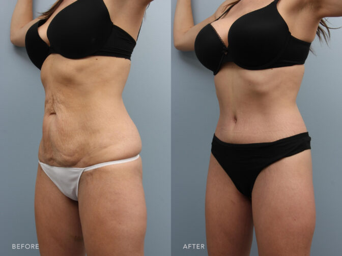 This is a photo of a woman's lower body before and after Lower Body Lift with Liposuction procedure. Before photo shows her unwanted and rumpled skin while after photo shows her well polished skin and evenly body shape. | Albany, Latham, Saratoga NY, Plastic Surgery”
