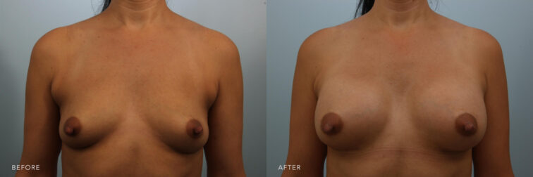 A photos of a woman's upper body before and after Breast Augmentation procedure. Before photo shows her pocket sized and droopy breasts while after photos shows her sizeable and full toned breasts. | Albany, Latham, Saratoga NY, Plastic Surgery