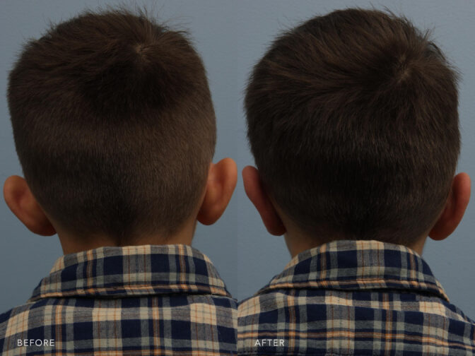 before and after of a young boys head taken from the back angle. before ear surgery his ears stuck out very far from his head. after surgery they are pinned back to normal position. | albany, latham, saratoga ny, plastic surgery