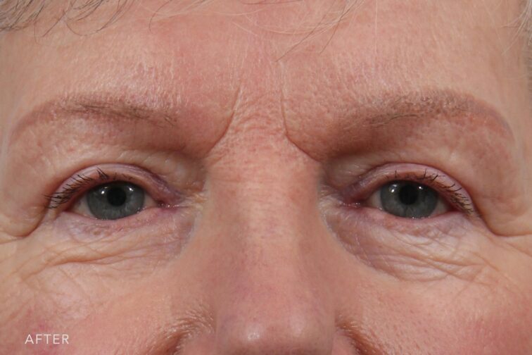This is a photo of a woman's upper face with her clearer view and full shaped eyes. | Albany, Latham, Saratoga NY, Plastic Surgery
